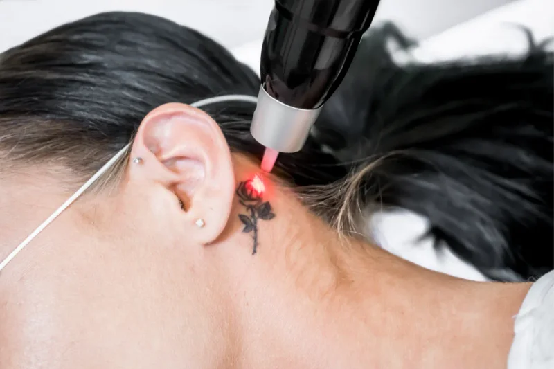 Laser entfernt ein kleines Tattoo im Nacken – vor der ersten Sitzung steht immer ein ausführliches Beratungsgespräch