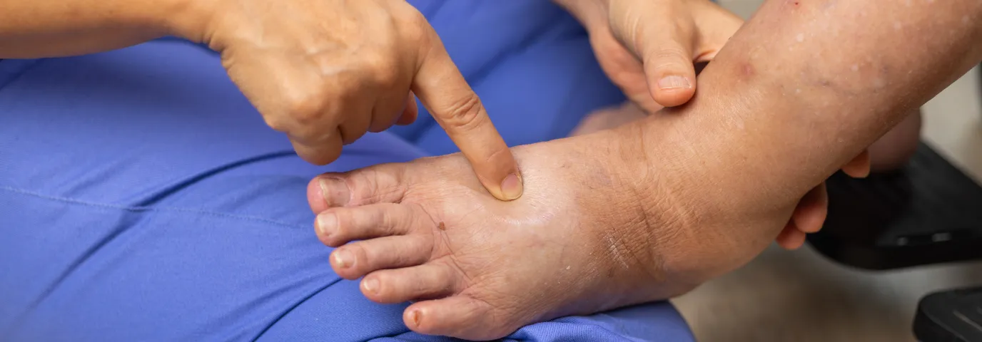 Diabetischer Fuß Pflege: Wann Podologie medizinisch notwendig wird