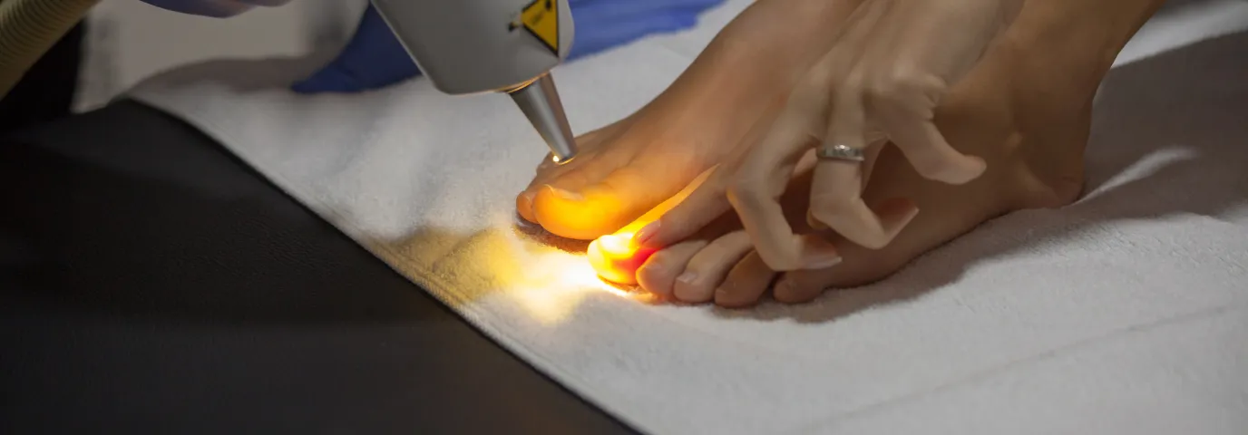 Laserbehandlung Nagelpilz: Wirksamkeit, Kosten & Therapie-Erfolg
