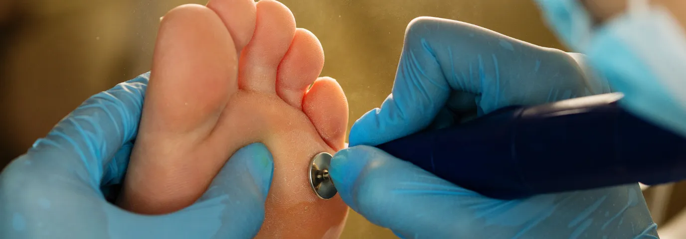 Medizinische Hornhautbehandlung: Qualitätskriterien & Standards in der Podologie