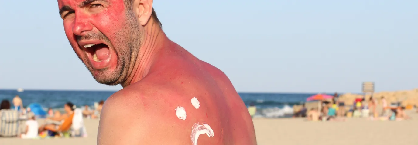 Sonnenbrand vermeiden: 6 effektive Tipps für optimalen Hautschutz